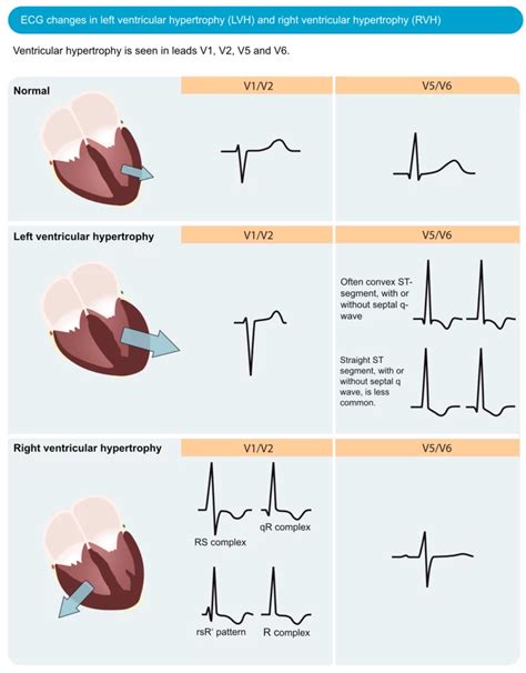 ecg lv hypertrophy|ecg in left ventricular hypertrophy.